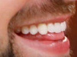 Picture of Blake Moynes teeth and smile