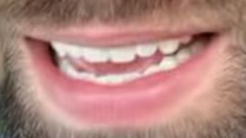 Picture of Blake Moynes teeth and smile