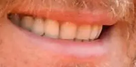 Picture of Blake Shelton teeth and smile