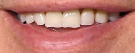 Brad Pitt's teeth and smile