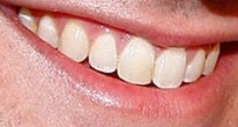 Picture of Brandon Barash teeth and smile