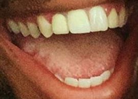 Picture of Brandon Leake teeth and smile