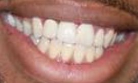 Picture of Brandon Leake teeth and smile