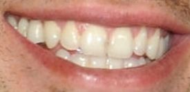 Picture of Brendon Villegas teeth and smile