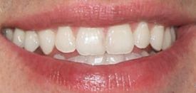 Picture of Brendon Villegas teeth and smile
