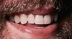 Picture of Brett Young teeth and smile