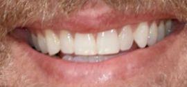 Picture of Brett Young teeth and smile