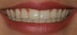 Britney Spears teeth