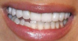 Brittny Gastineau teeth
