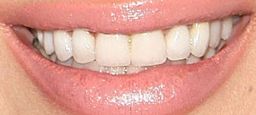 Brittny Gastineau teeth
