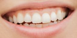 Picture of Brooke Markham teeth and smile