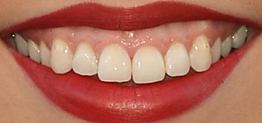 Picture of Brooke Markham teeth and smile
