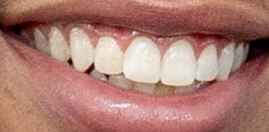 Bryshere Gray teeth