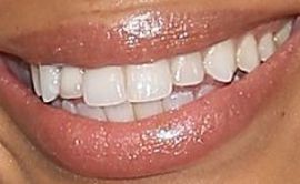 Picture of Brytni Sarpy teeth and smile