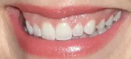 Picture of Caitlin McGee teeth and smile