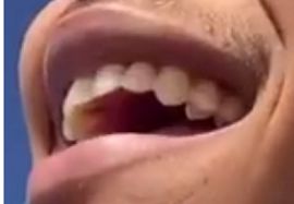 Picture of Cam Anthony teeth and smile