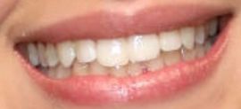 Camila Cabello's teeth