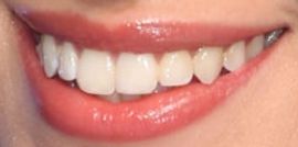 Camila Cabello's teeth