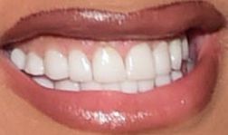 Cardi B teeth