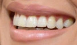 Carrie Underwood teeth