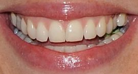 Picture of Cat Deeley teeth and smile