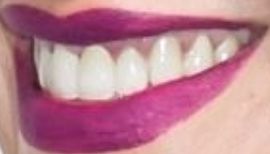 Picture of Catherine Siachoque teeth and smile