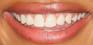 Picture of Chandler Kinney teeth and smile