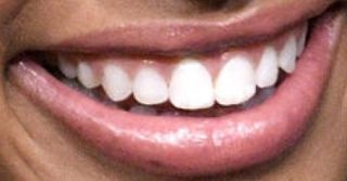 Picture of Chandler Kinney teeth and smile