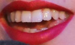 Picture of Charli XCX teeth and smile