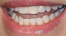 Charlize Theron teeth and smile