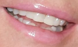 Picture of Cheryl Tiegs teeth and smile
