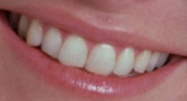 Picture of Cheryl Tiegs teeth and smile
