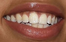 Picture of Chloe Bailey teeth and smile