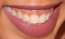 Picture of Chloe Bailey teeth and smile