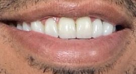 Picture of Chris Bridges Ludacris teeth and smile
