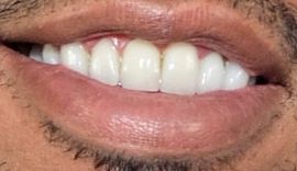 Picture of Chris Bridges Ludacris teeth and smile