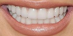 Picture of Chrissy Teigen teeth and smile
