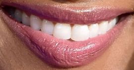 Picture of Ciara teeth and smile