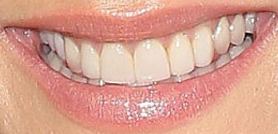 Picture of Clare Crawley teeth and smile