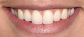 Picture of Cole Sprouse teeth and smile