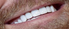 Conor McGregor's teeth