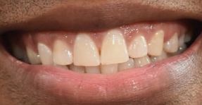Picture of Corey Hawkins teeth and smile