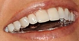 Picture of Courtney Robertson teeth and smile