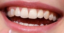 Dakota Fanning's teeth