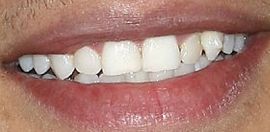 Picture of Dale Moss teeth and smile