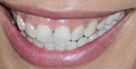 Picture of Danay Garcia teeth and smile