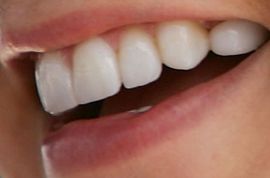 Danica Patrick teeth and smile