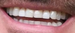 Picture of David Beckham teeth and smile