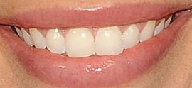 Picture of DeAnna Pappas teeth and smile
