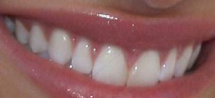Picture of Demi Lovato's teeth while smiling
